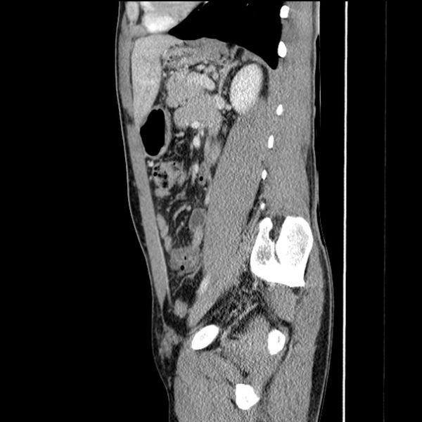 File:Acute appendicitis (Radiopaedia 27049-27227 Sagittal C+ portal venous phase 52).jpg