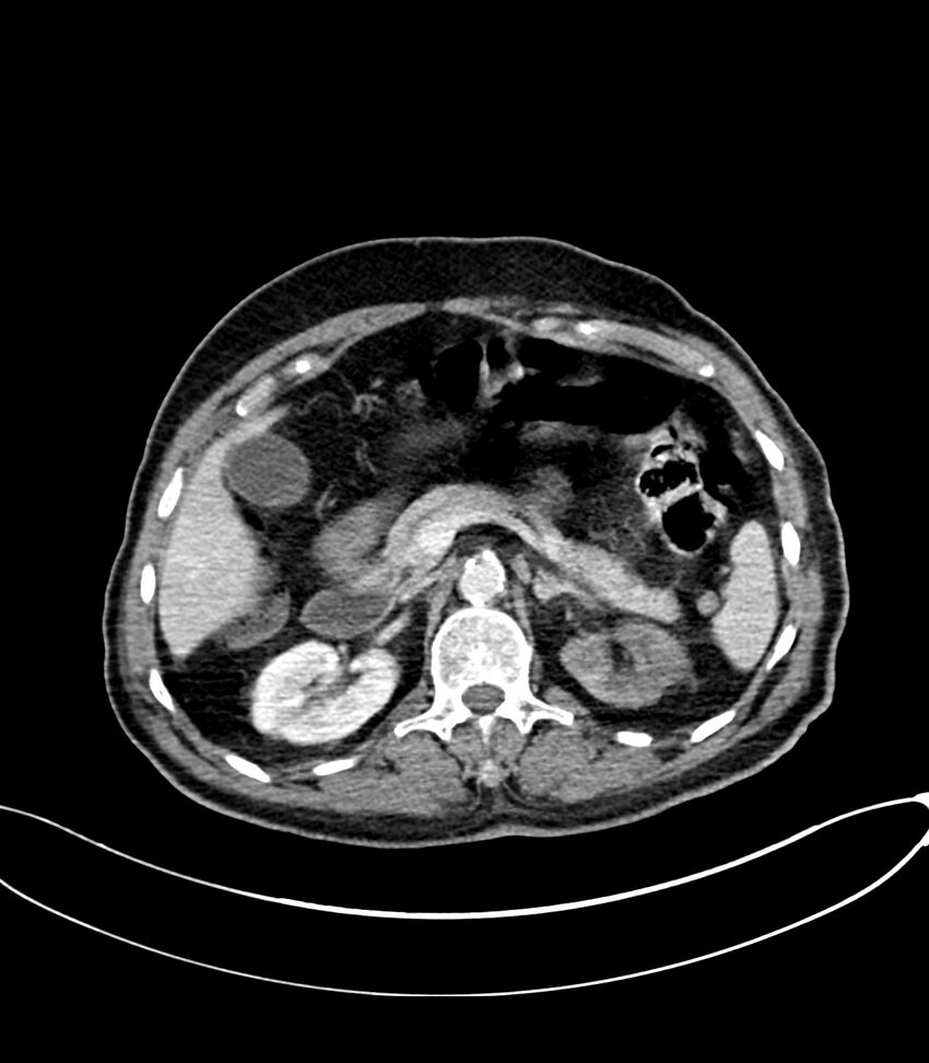 Acute arterial mesenteric ischemia (Radiopaedia 78238-90828 Axial C+ portal venous phase 47).jpg