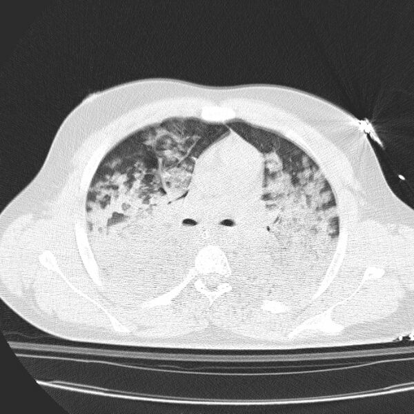 File:Acute aspiration pneumonitis (Radiopaedia 33605-34703 Axial lung window 42).jpg
