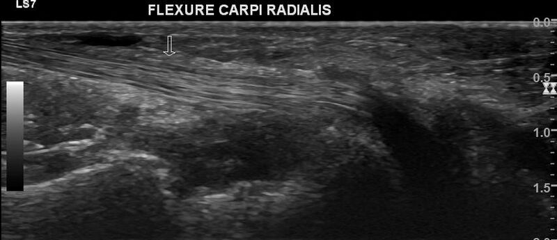 File:Acute calcific periarthritis - wrist (Radiopaedia 76310).jpg