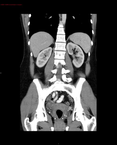 File:Acute gastritis (Radiopaedia 21043-20975 Coronal C+ portal venous phase 6).jpg