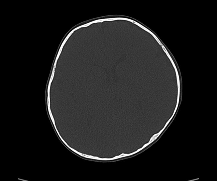File:Acute hemorrhagic contusion (Radiopaedia 63660-72336 Axial bone window 37).jpg