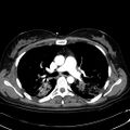 Acute myocardial infarction in CT (Radiopaedia 39947-42415 Axial C+ arterial phase 54).jpg