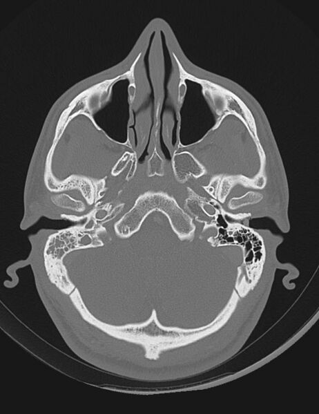 File:Acute otomastoiditis (Radiopaedia 28329-28575 Axial bone window 2).jpg