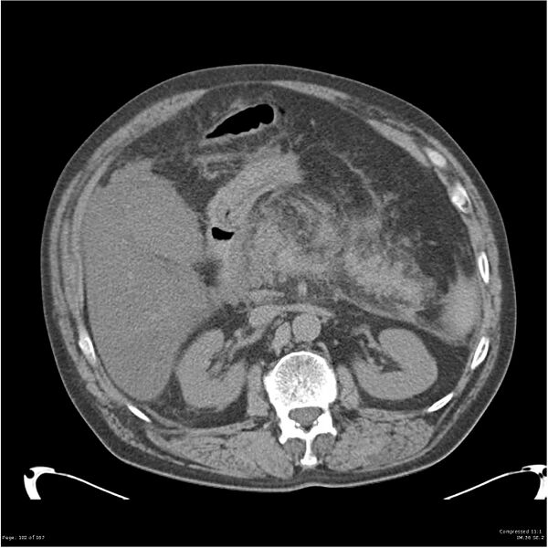 File:Acute pancreatitis (Radiopaedia 19135-19116 Axial non-contrast 16).jpg