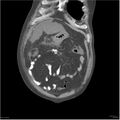 Acute pancreatitis (Radiopaedia 19135-19116 Coronal non-contrast 4).jpg