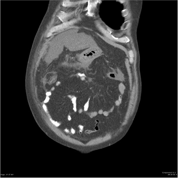 File:Acute pancreatitis (Radiopaedia 19135-19116 Coronal non-contrast 4).jpg
