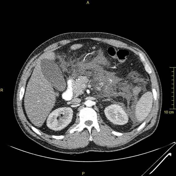 File:Acute pancreatitis (Radiopaedia 23231-23290 Axial C+ arterial phase 49).JPG
