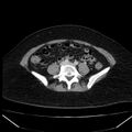 Acute pancreatitis - Balthazar C (Radiopaedia 26569-26714 Axial C+ portal venous phase 66).jpg