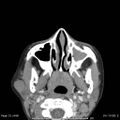 Acute parotitis (Radiopaedia 54123-60294 Axial C+ arterial phase 3).jpg