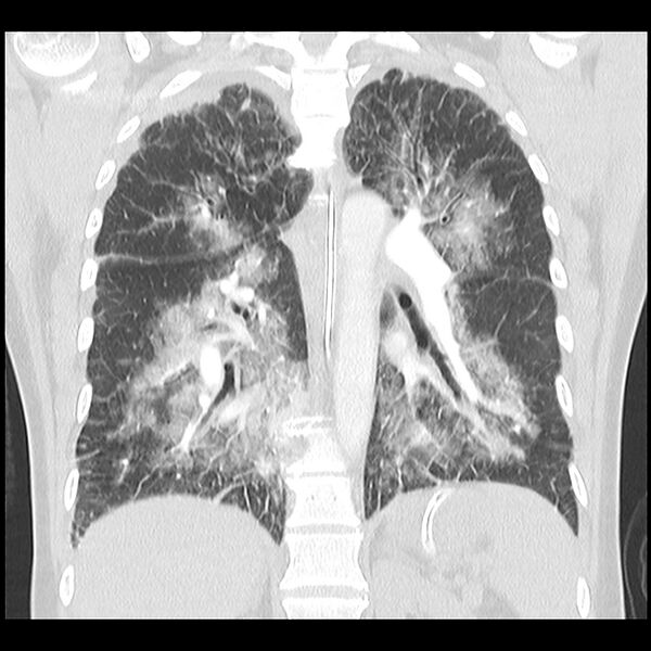 File:Acute pulmonary edema on CT (Radiopaedia 33582-34672 Coronal lung window 24).jpg