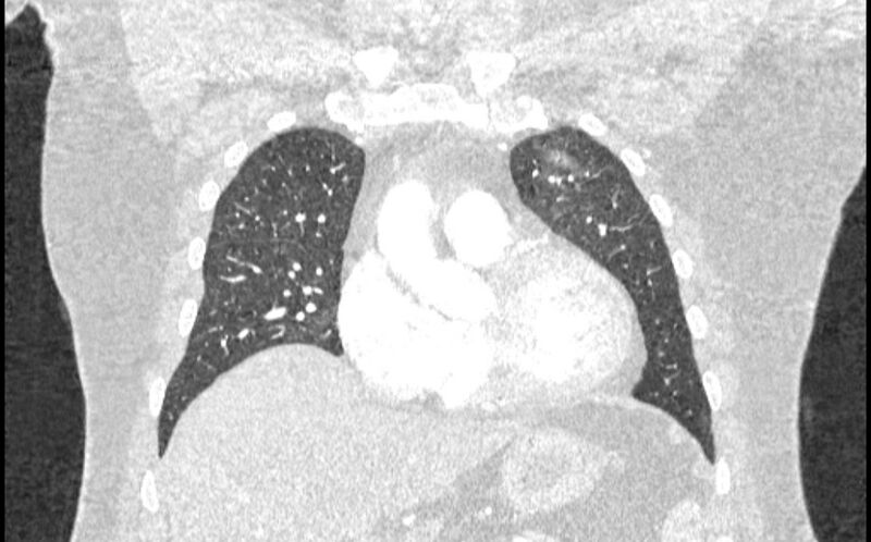 File:Acute pulmonary embolism with pulmonary infarcts (Radiopaedia 77688-89908 Coronal lung window 22).jpg
