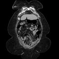 Acute pyelonephritis (Radiopaedia 25657-25837 Coronal renal parenchymal phase 22).jpg