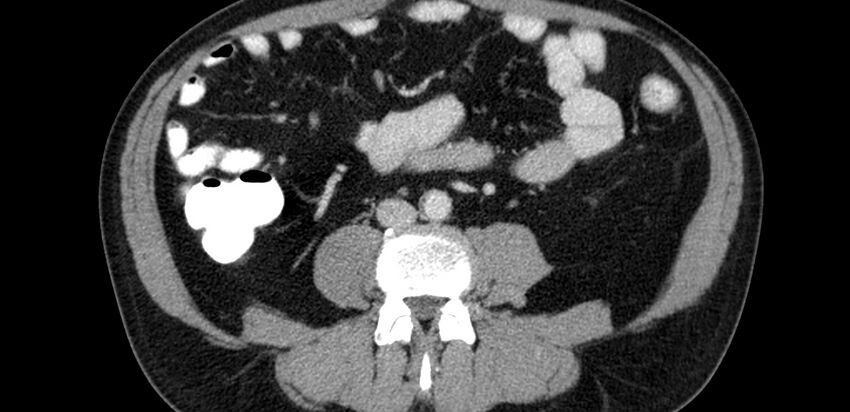Acute sigmoid colon diverticulitis (Radiopaedia 55507-61976 Axial C+ portal venous phase 37).jpg