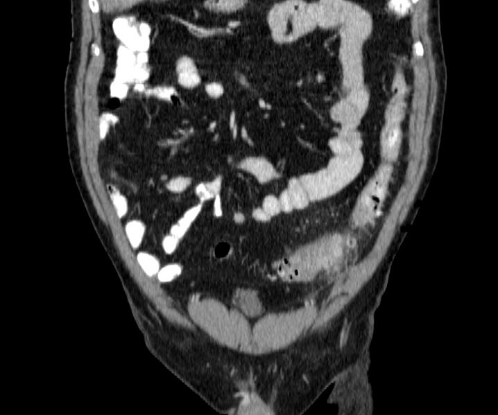 File:Acute sigmoid colon diverticulitis (Radiopaedia 55507-61976 Coronal C+ portal venous phase 33).jpg