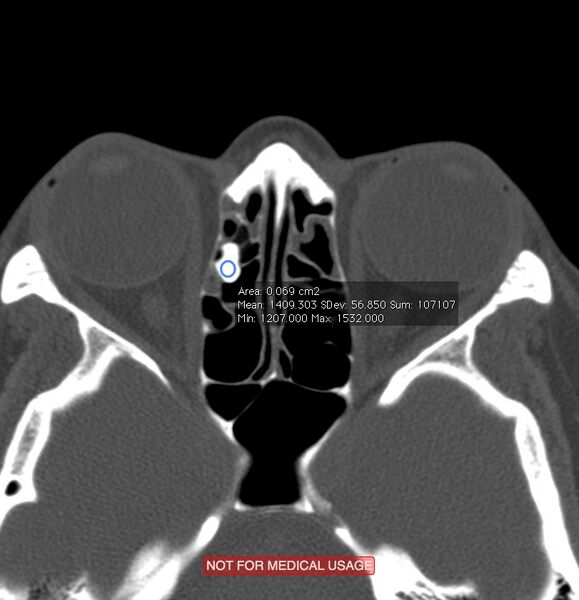 File:Acute sinusitis (Radiopaedia 22419-22455 Axial bone window 1).jpg