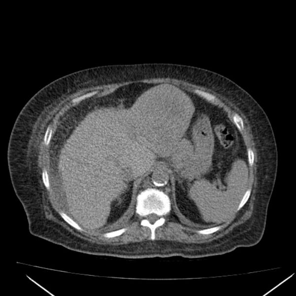 File:Acute tubular necrosis (Radiopaedia 28077-28334 Axial non-contrast 17).jpg