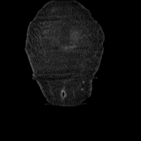 File:Acute tubular necrosis (Radiopaedia 28077-28334 D 8).jpg