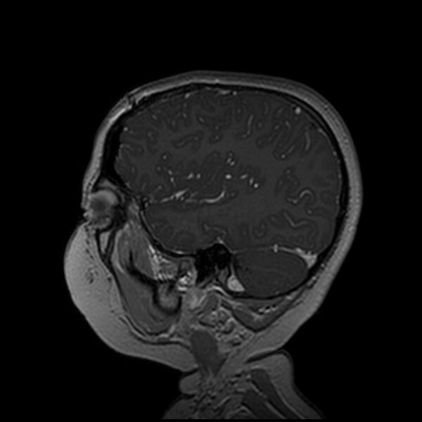 File:Adamantinomatous craniopharyngioma (Radiopaedia 77407-89529 H 29).jpg