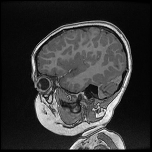 File:Adamantinomatous craniopharyngioma (Radiopaedia 77407-89529 Sagittal T1 C+ 31).jpg