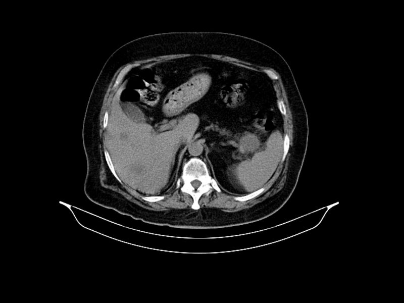 File:Adenocarcinoma of pancreas with hepatic metastasis (Radiopaedia 64332-73122 Axial non-contrast 30).jpg