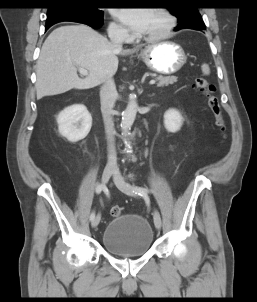 File:Adenocarcioma of rectum- T1 lesion (Radiopaedia 36921-38547 Coronal C+ portal venous phase 33).png