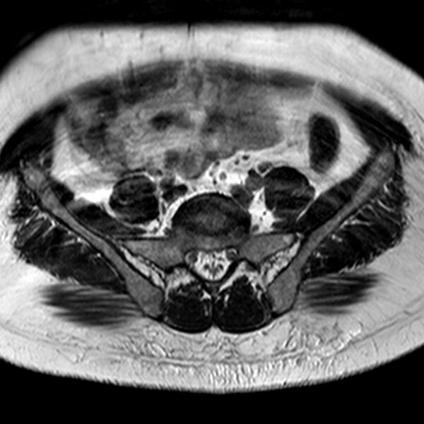 File:Adenomyoma of the uterus (Radiopaedia 9871-10439 Axial T2 30).jpg