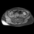Adenomyoma of the uterus (huge) (Radiopaedia 9870-10438 Axial T1 fat sat 23).jpg