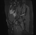 Adenomyosis - ovarian endometriomas (Radiopaedia 67031-76350 Sagittal T1 C+ fat sat 2).jpg