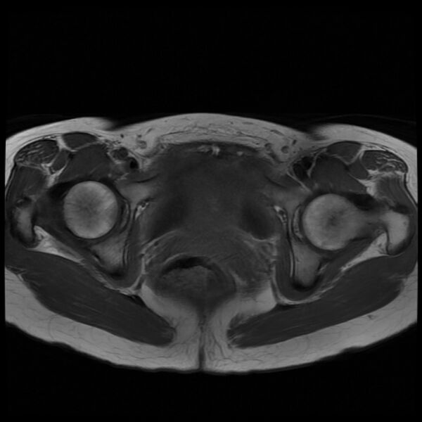 File:Adenomyosis on MRI (Radiopaedia 29328-29780 Axial T1 9).jpg