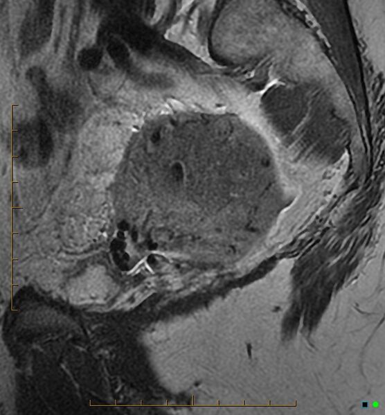 File:Adenomyosis uterus with hematometra (Radiopaedia 45779-50011 Sagittal T2 8).jpg