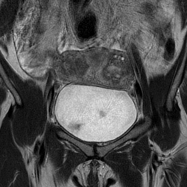 File:Adenomyosis within a septate uterus (Radiopaedia 69963-79981 Coronal T2 7).jpg