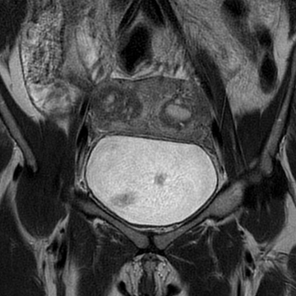 File:Adenomyosis within a septate uterus (Radiopaedia 69963-79981 Coronal T2 8).jpg
