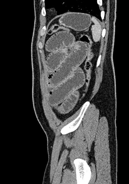 File:Adhesional small bowel obstruction (Radiopaedia 58900-66131 Sagittal C+ portal venous phase 212).jpg