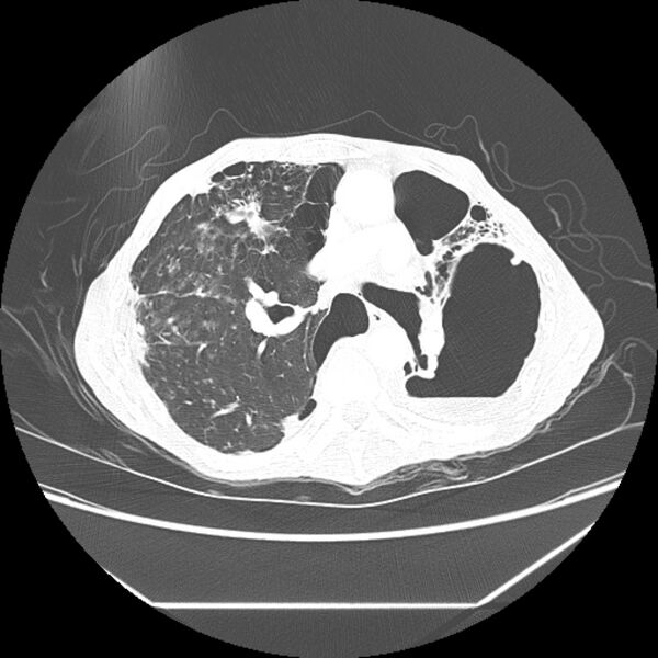 File:Advanced pulmonary tuberculosis (Radiopaedia 8599-9431 Axial lung window 24).jpg
