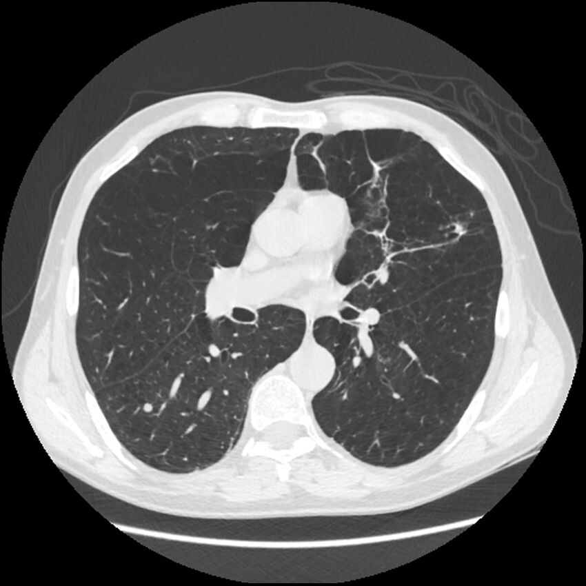 Alpha-1-antitrypsin deficiency (Radiopaedia 40993-43722 Axial lung window 119).jpg