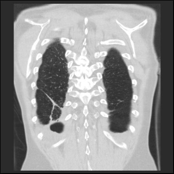 File:Alpha-1-antitrypsin deficiency (Radiopaedia 40993-43722 Coronal lung window 92).jpg