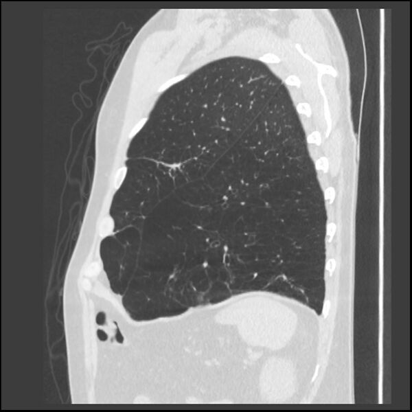 File:Alpha-1-antitrypsin deficiency (Radiopaedia 40993-43722 Sagittal lung window 51).jpg