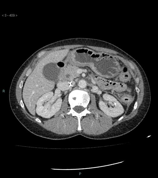 File:Ampulla of Vater metastasis (Radiopaedia 27820-28069 A 47).jpg