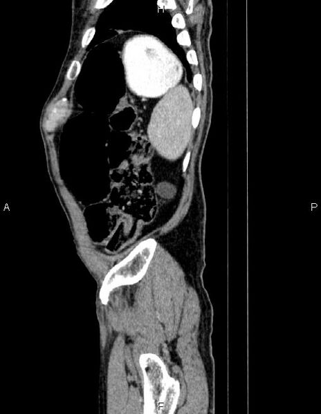 File:Ampullary adenocarcinoma (Radiopaedia 86093-102032 D 87).jpg