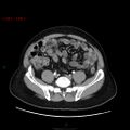 Ampullary carcinoma (Radiopaedia 56396-63056 B 54).jpg