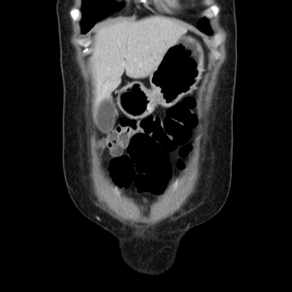 File:Ampullary tumor (Radiopaedia 22787-22816 E 11).jpg