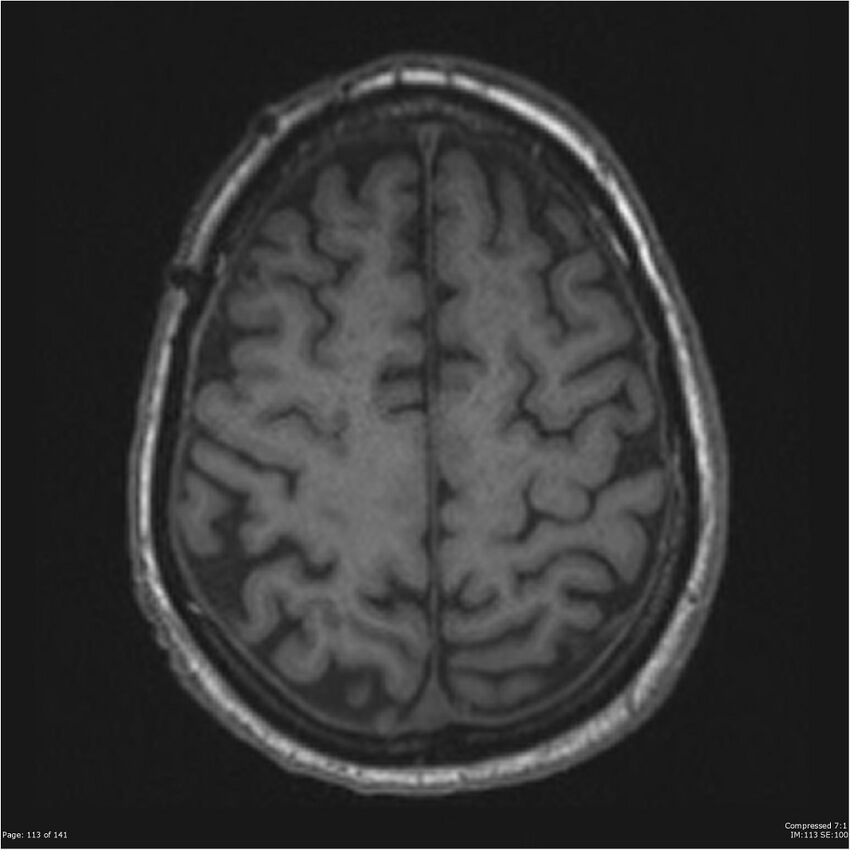 Anaplastic meningioma with recurrence (Radiopaedia 34452-35788 Axial T1 111).jpg