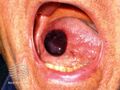 Angina bullosa haemorrhagica (DermNet NZ site-age-specific-angina-bullosa).jpg