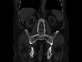 Ankylosing spondylitis (Radiopaedia 44609-48357 Coronal bone window 56).jpg