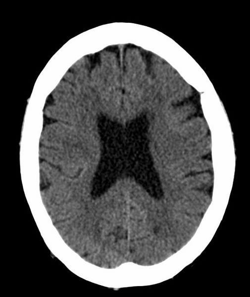 File:Anomalous intracranial venous drainage (Radiopaedia 28161-28418 Axial 28).png