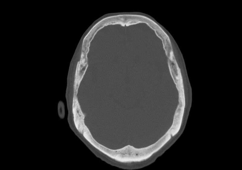 File:Anomalous intracranial venous drainage (Radiopaedia 28161-28418 Axial bone window 17).jpg