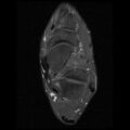 Anterior calcaneal process fracture (Radiopaedia 74654-85611 Axial PD fat sat 13).jpg