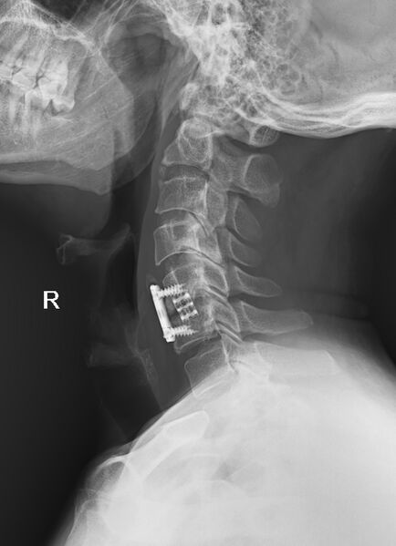 File:Anterior cervical discectomy and fusion (ACDF) (Radiopaedia 70491-80610 Lateral 1).jpg