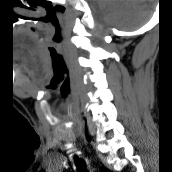 File:Anterior cervical postdiscectomy arthrodesis (Radiopaedia 32678-33646 C 14).jpg